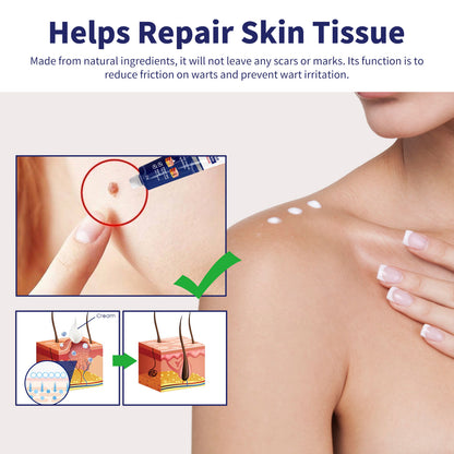 XIMONTH Wart Removal Cream for Skin Repair and Care