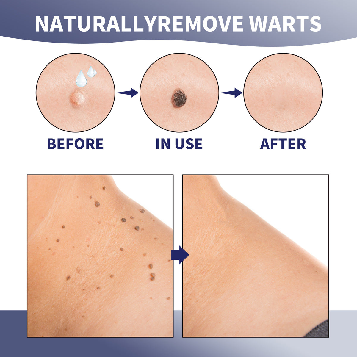 XIMONTH Wart Removal Cream for Skin Repair and Care