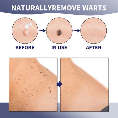 XIMONTH Wart Removal Cream for Skin Repair and Care