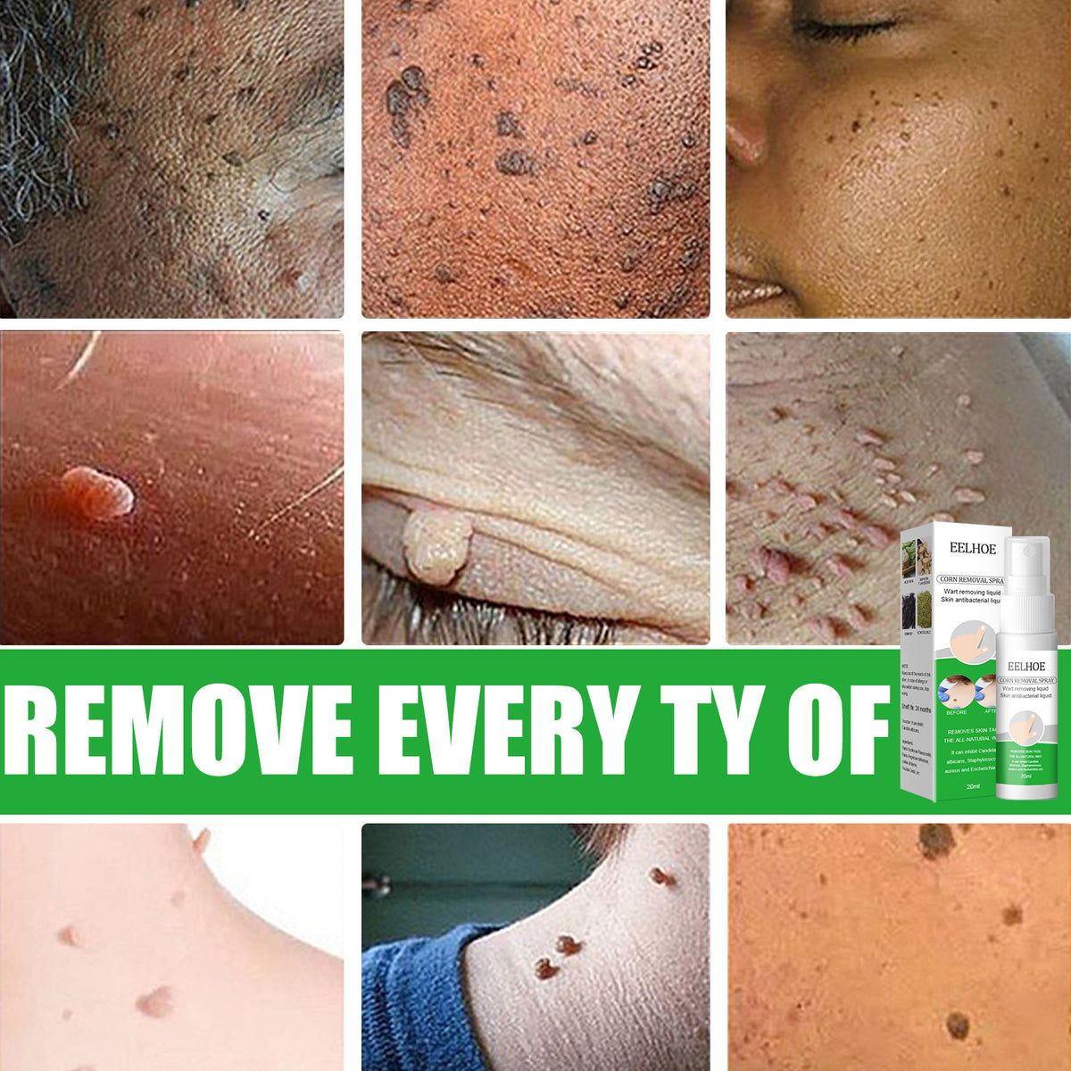 EELHOE Wart Removal Liquid for Skin Growths